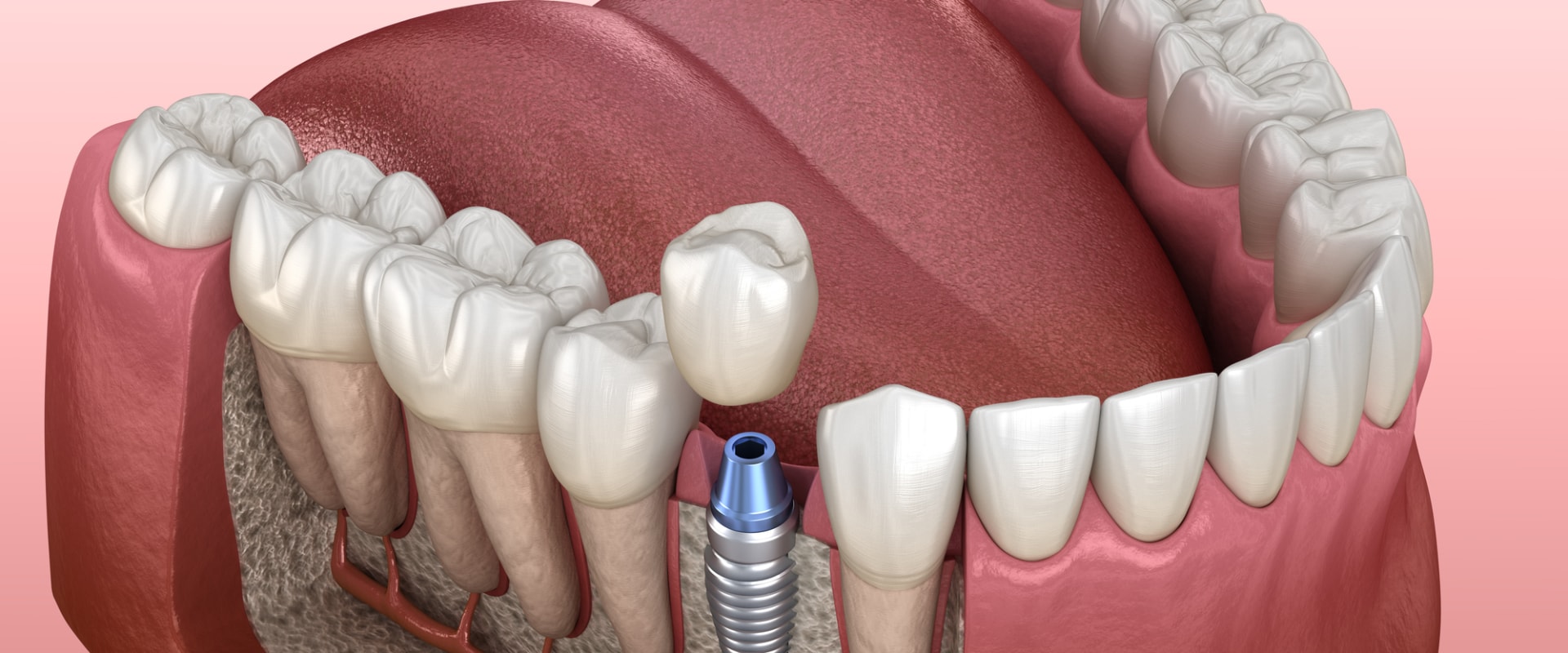 Do I Need Good Jawbone Density for Dental Implants?