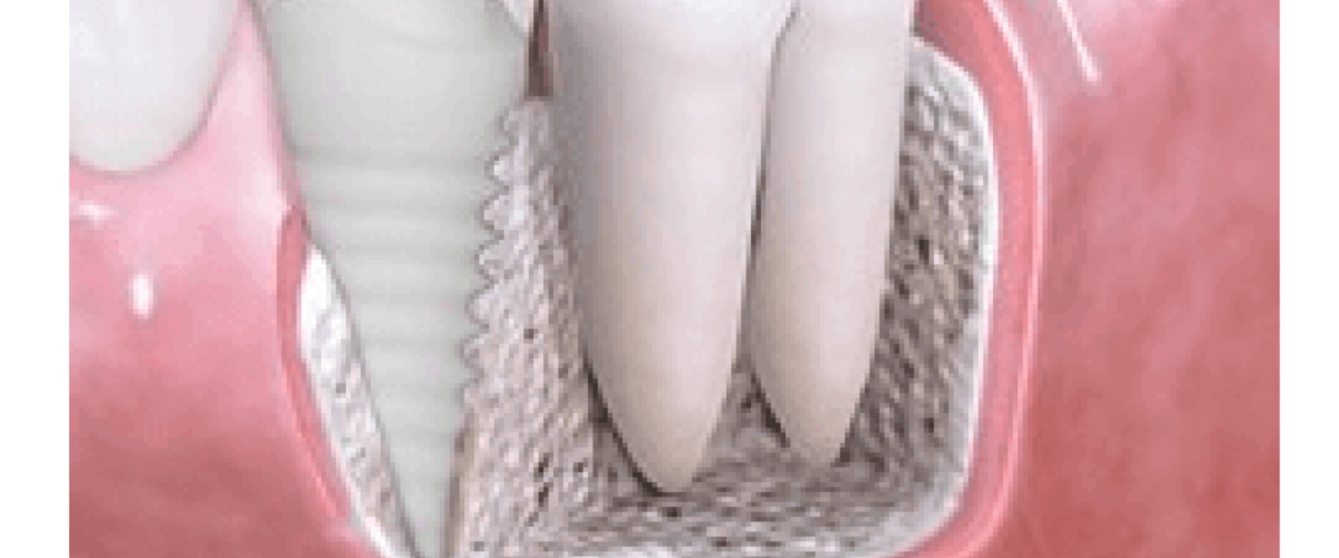 Recovery Time for Dental Implants: What You Need to Know