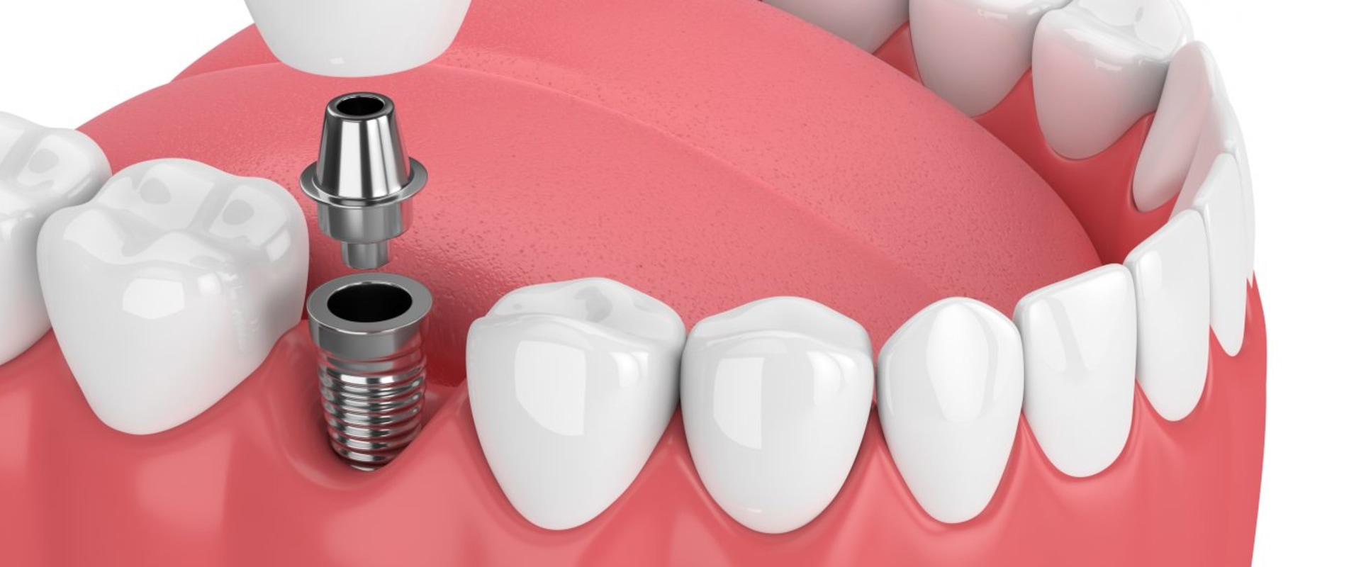 How Long Do Teeth Implants Last? An Expert's Guide to Longevity
