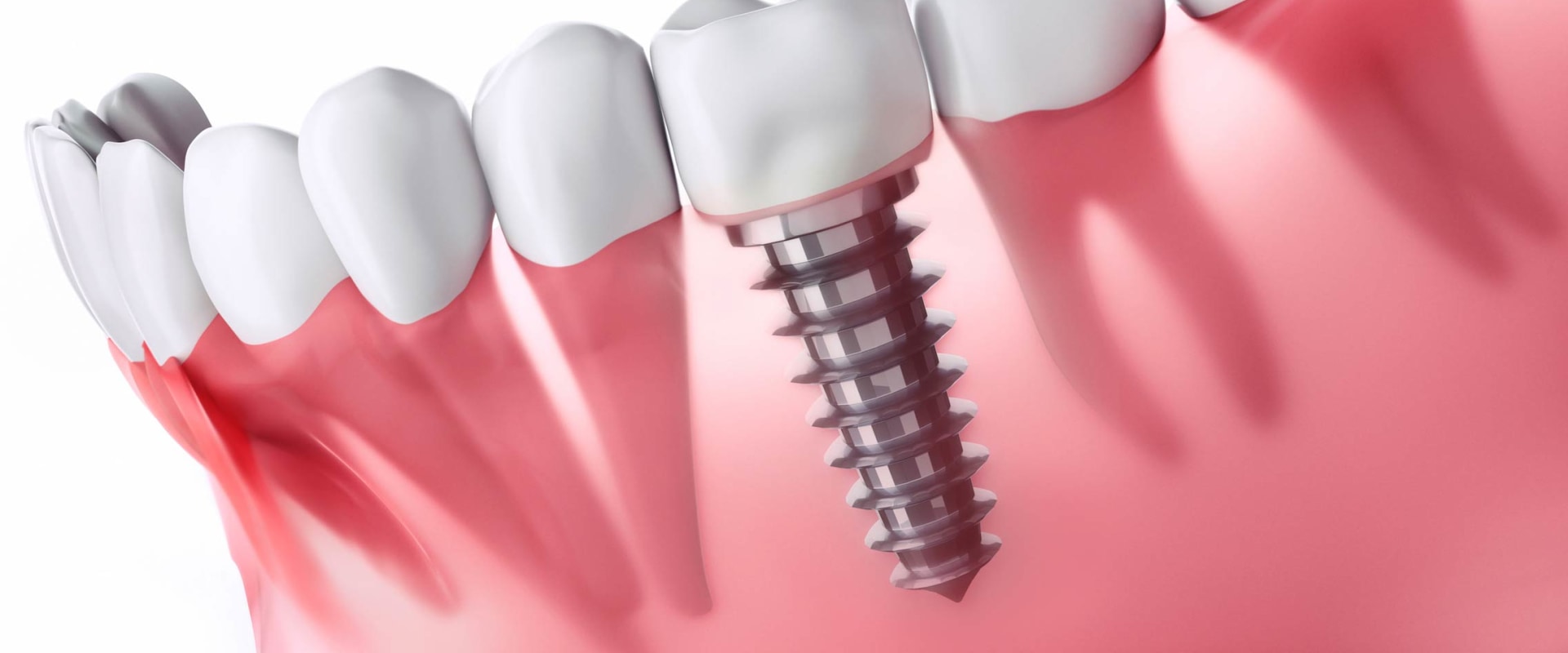 What is Stage 2 of a Dental Implant Procedure? - An Expert's Guide