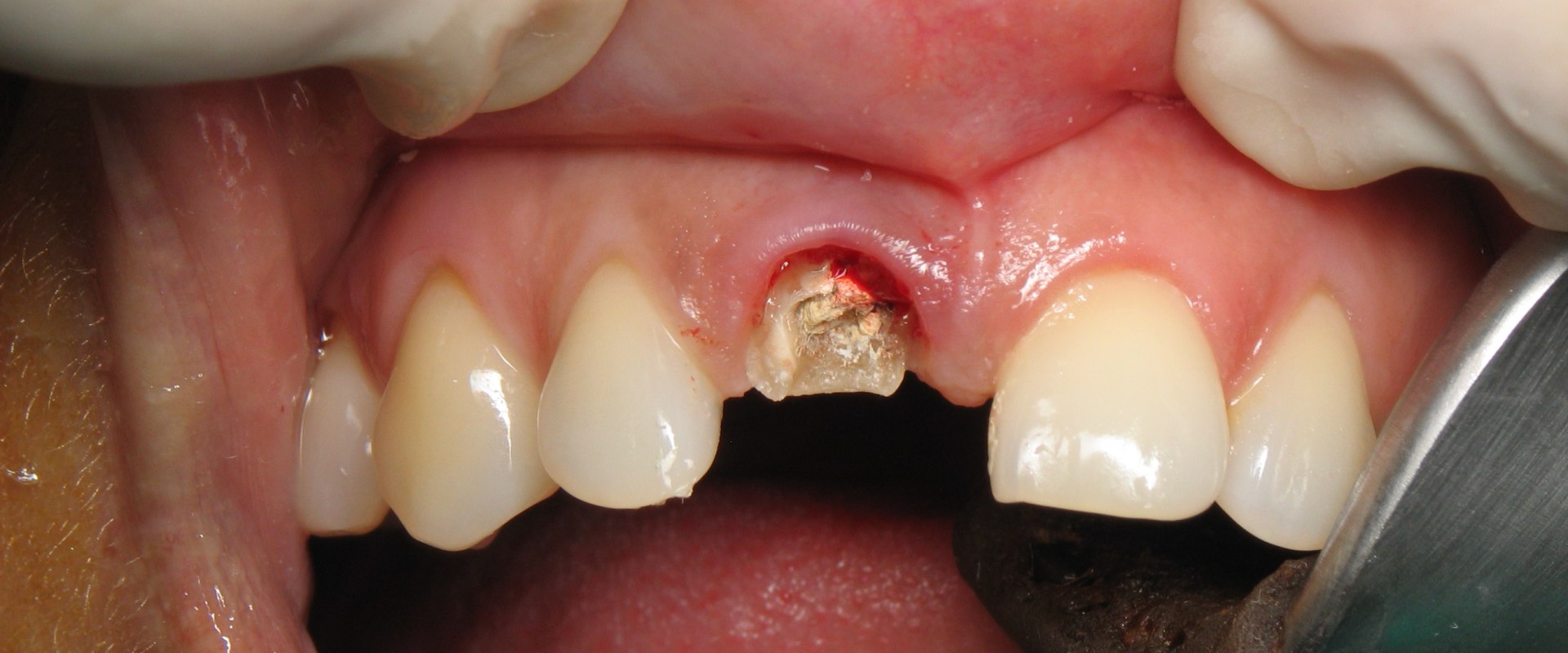 How Long Does it Take to Get a Dental Implant? - An Expert's Perspective