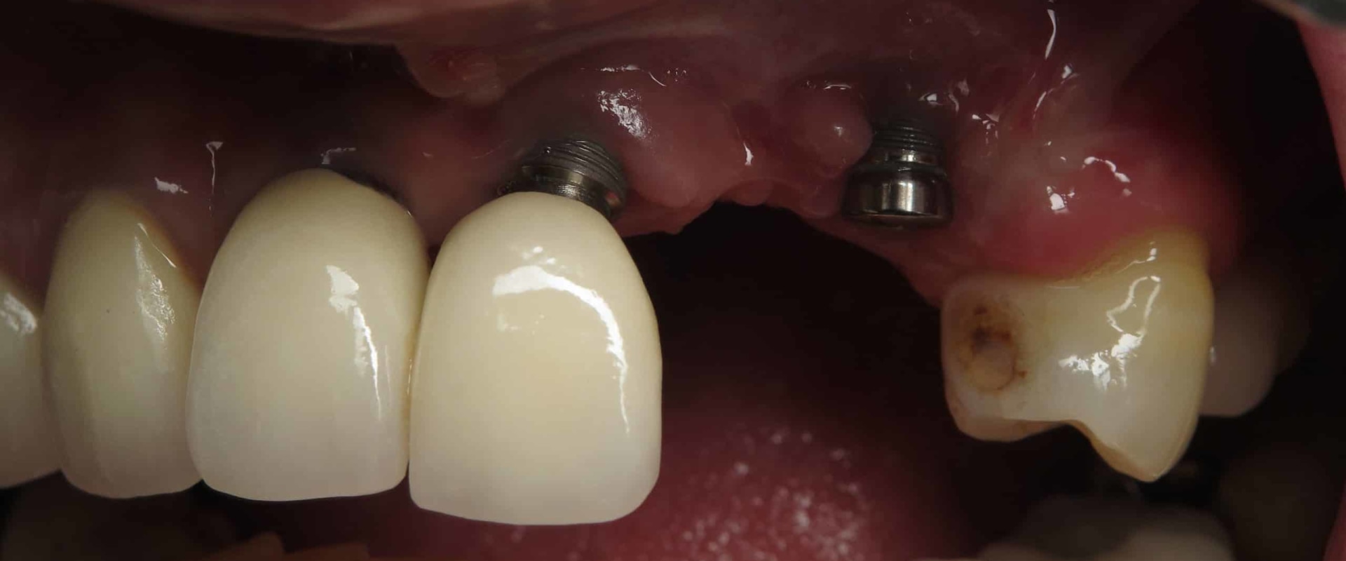 Do Dental Implants Ever Fail? An Expert's Guide