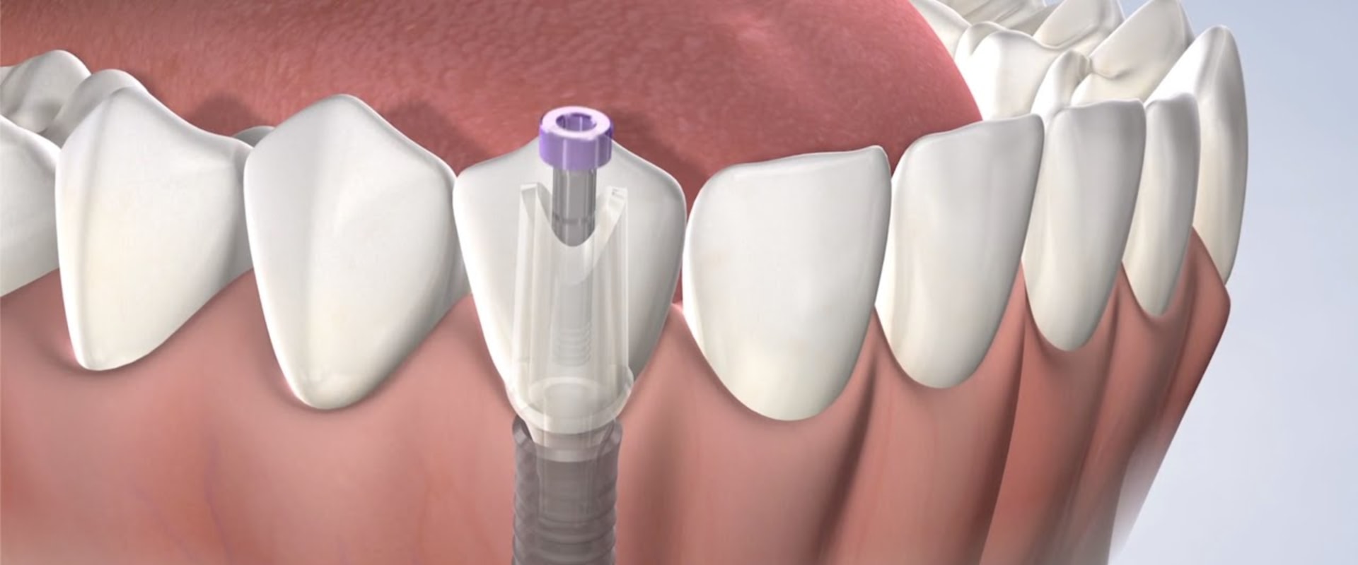 How Long Should You Take Off Work for Dental Implants? A Guide to Recovery