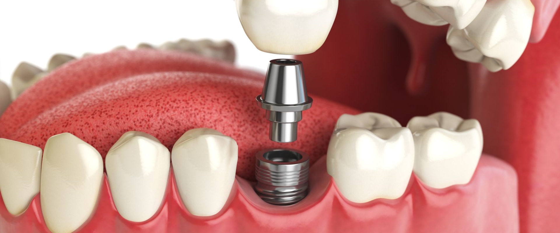 Medications to Avoid After Getting a Dental Implant: An Expert's Guide