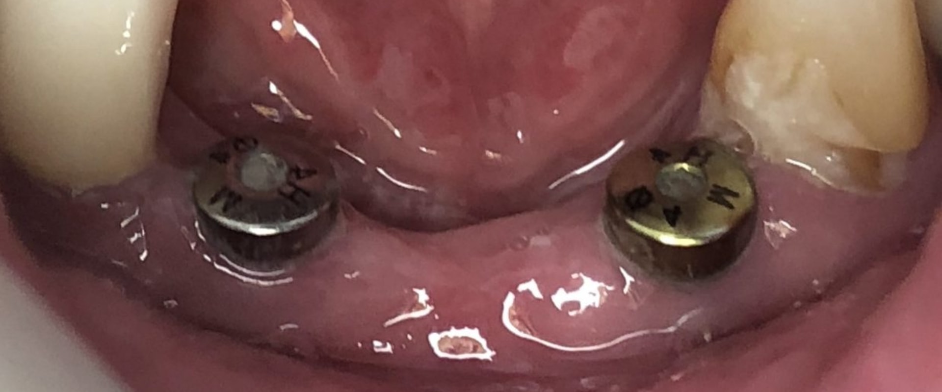 Do I Need an Oral Surgeon or a General Dentist for My Dental Implant?