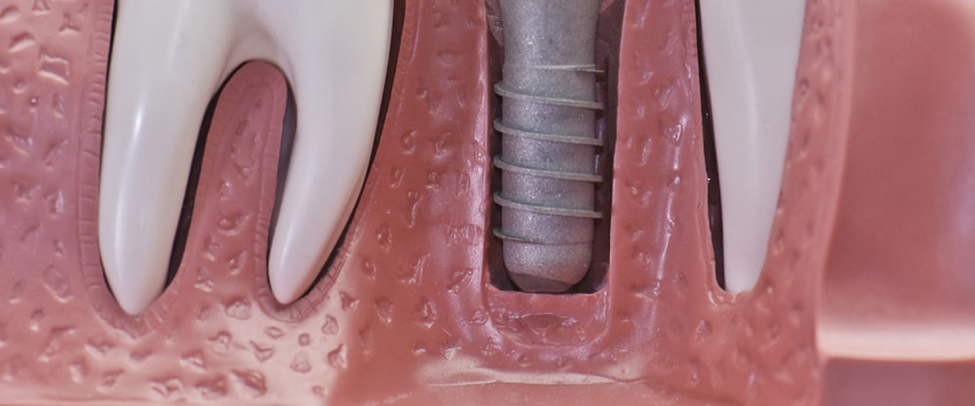 What is the Cost of Dental Implants? A Comprehensive Guide