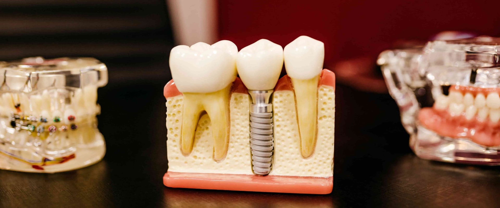 What are the Risks of Dental Implants?