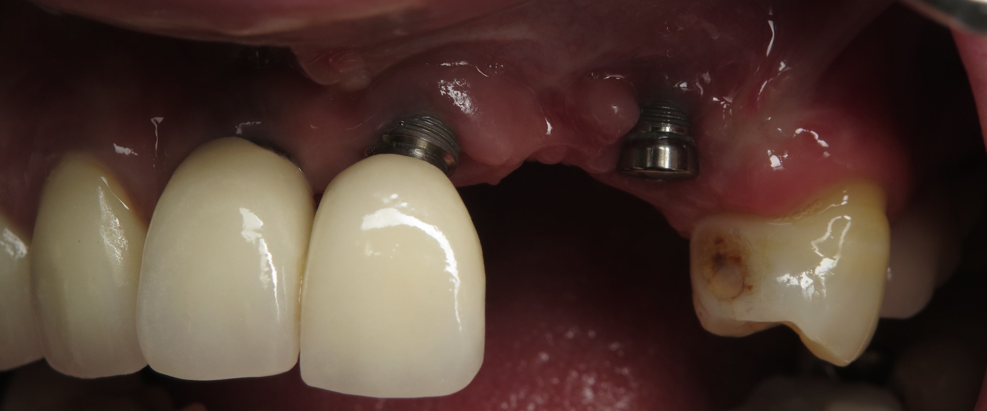 What to Know After Dental Implant Surgery