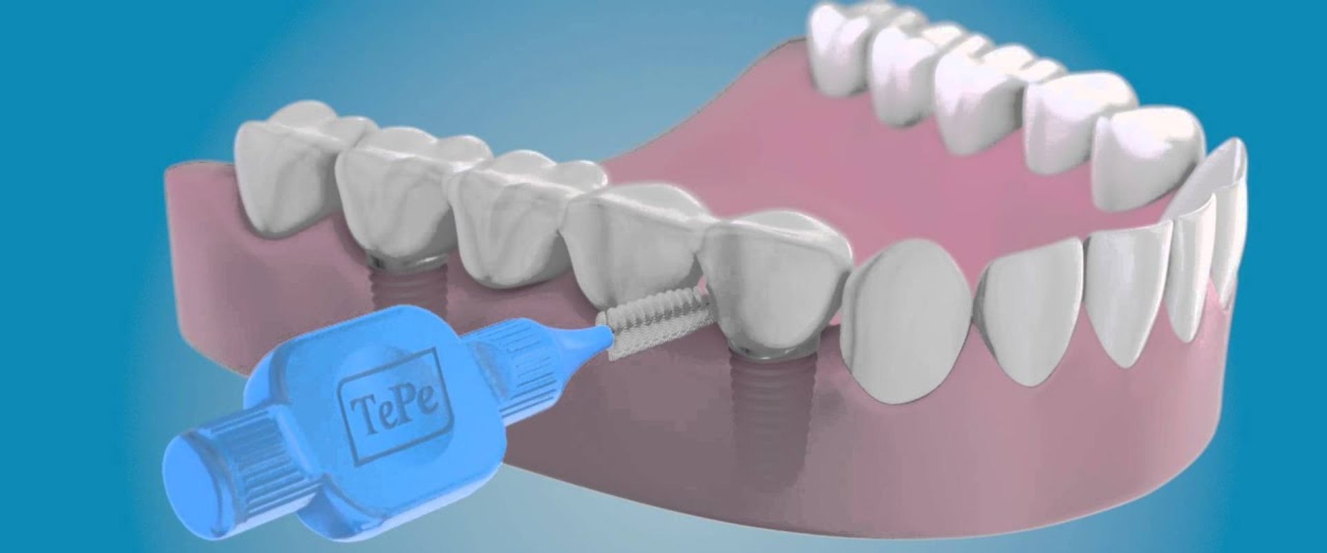 Caring for Teeth with Dental Implants: A Guide to Oral Hygiene