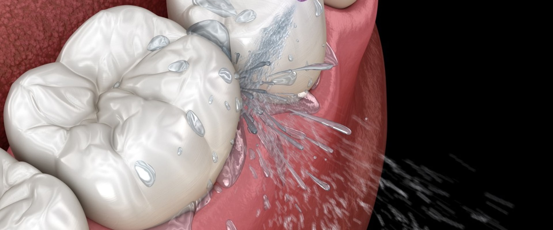 How to Keep Your Teeth Implants Clean and Healthy: A Guide for Oral Hygiene
