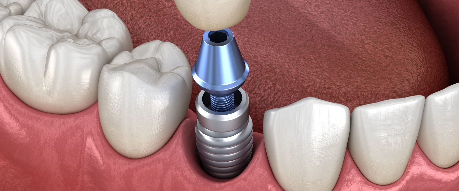 Do I Need to Take Time Off Work After Dental Implant Surgery?