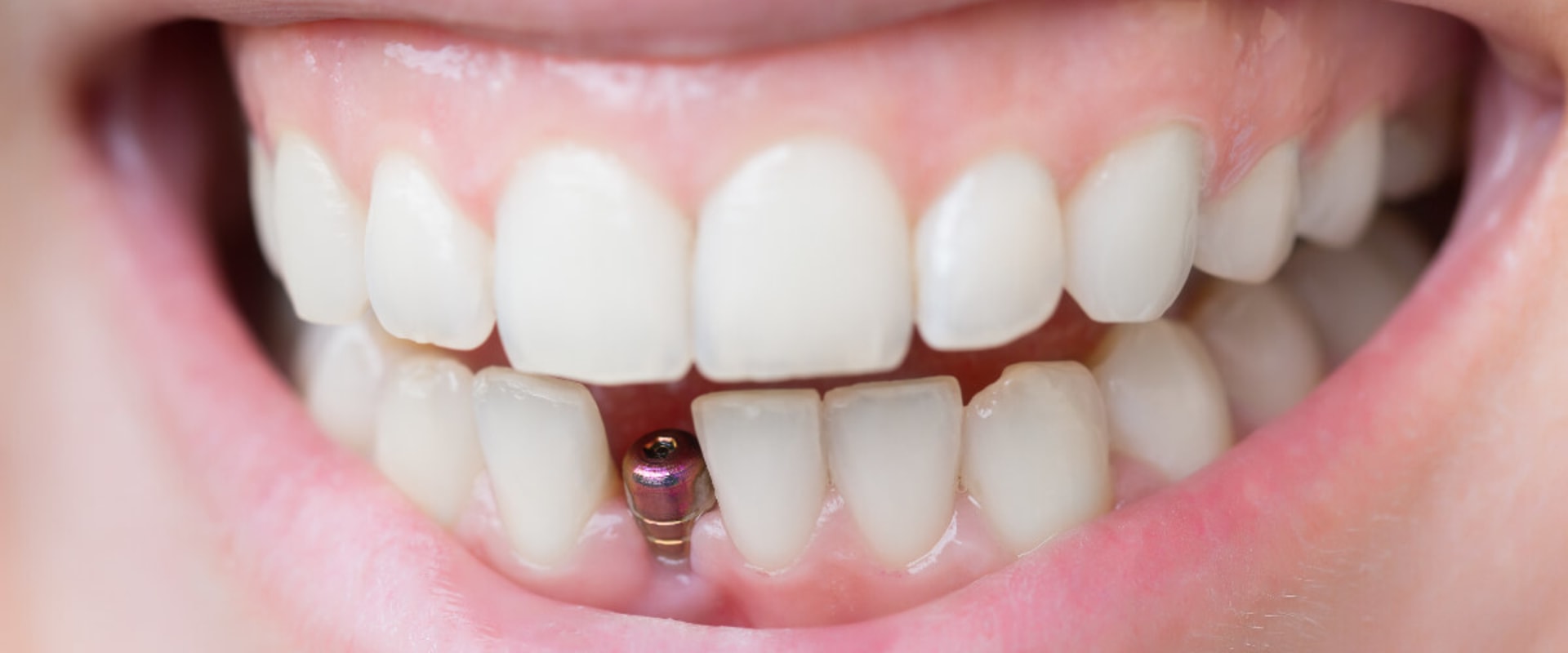 Speeding Up Healing After Dental Implant Surgery