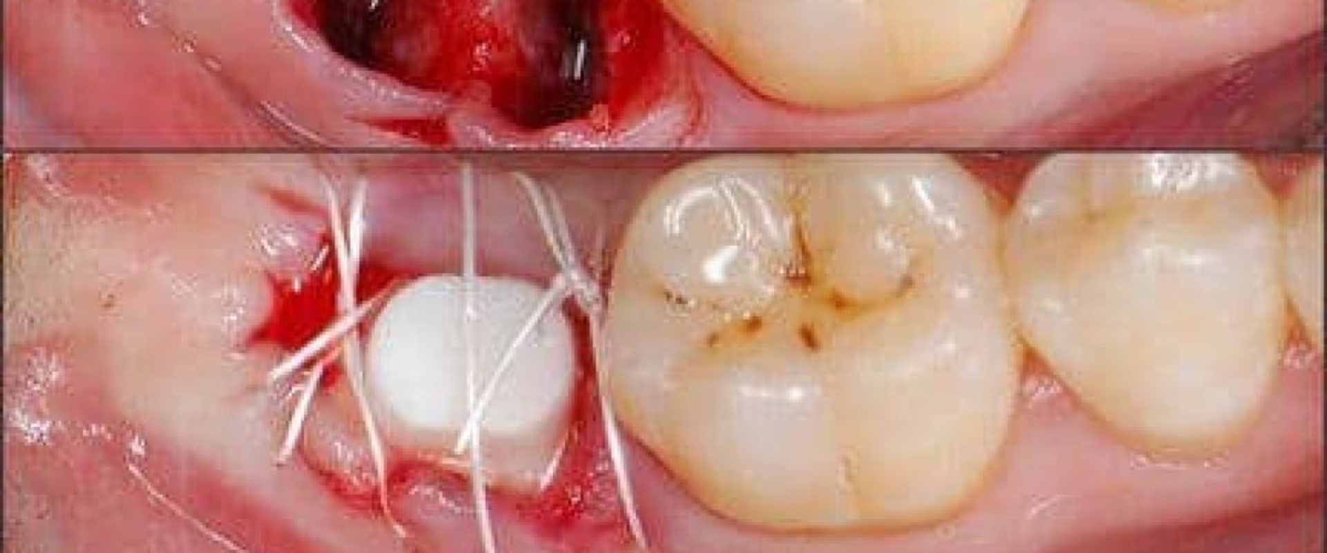 How Long Does the Pain From a Dental Implant Last? - An Expert's Perspective