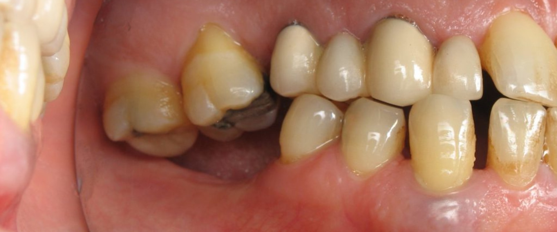 The Benefits of Dental Implants: Why You Shouldn't Wait to Get Them