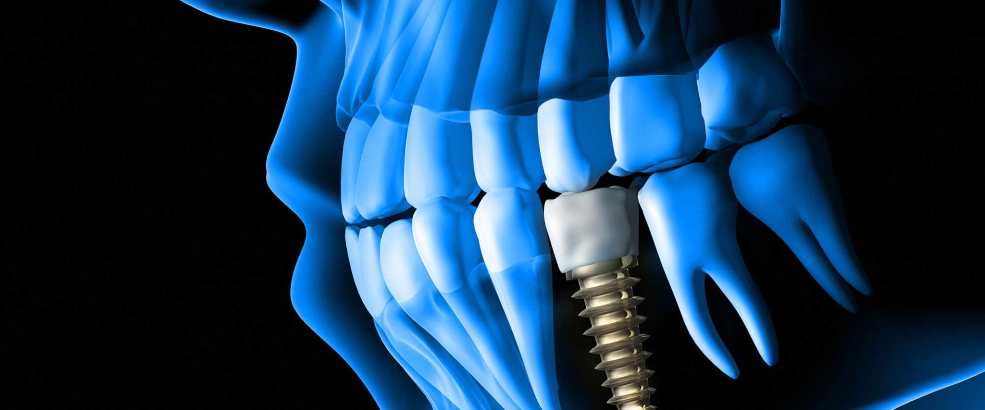How Much Does it Cost to Get Dental Implants in Alabama?
