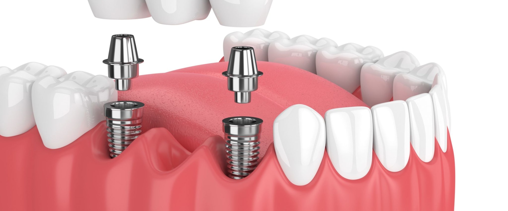 What is the Process of Getting Dental Implants?