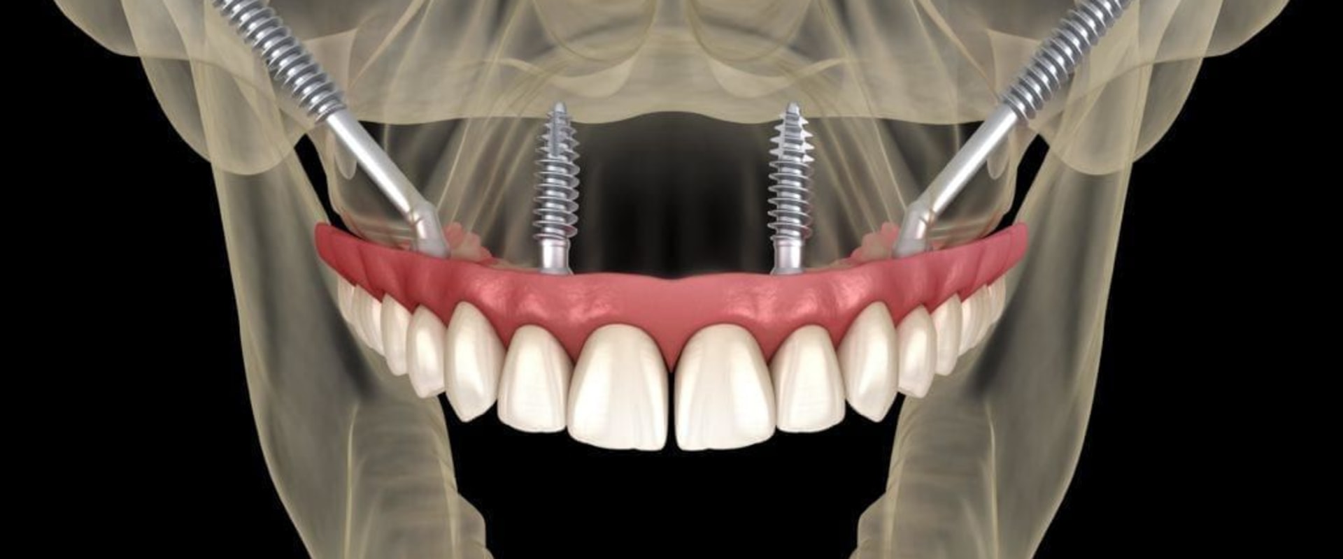 Can I Get a Dental Implant After a Sinus Lift Procedure?