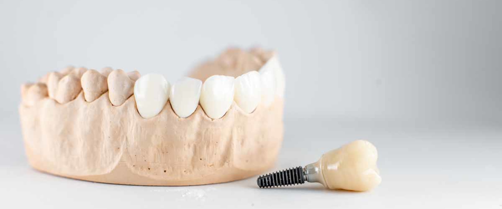 What are the Main Reasons for Dental Implant Failure?