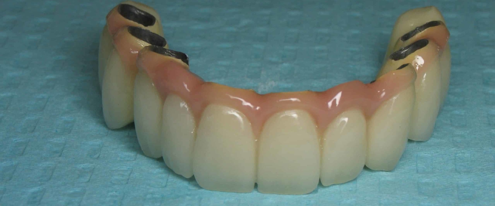 Which Option is Best for Replacing Missing Teeth: Dental Implants or Bridges?