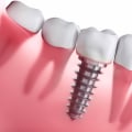 What is Stage 2 of a Dental Implant Procedure? - An Expert's Guide