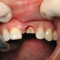 How Long Does it Take to Get a Dental Implant? - An Expert's Perspective