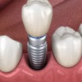The Pros and Cons of Dental Bridges and Implants: What You Need to Know