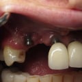 Do Dental Implants Ever Fail? An Expert's Guide
