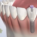 How Long Should You Take Off Work for Dental Implants? A Guide to Recovery