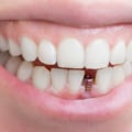 The Last Stage of a Dental Implant: What to Expect