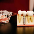 What are the Risks of Dental Implants?
