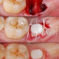How Long Does it Take for Gums to Heal After Implant Surgery?