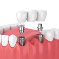 Getting a Dental Implant: A Comprehensive Step-by-Step Guide