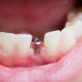 What's the Next Step After a Dental Implant is Placed? - A Comprehensive Guide