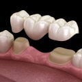 The Pros and Cons of Dental Bridges: A Comprehensive Guide