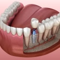 Which Bone Density is Best for Dental Implants? A Comprehensive Guide