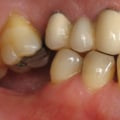 The Benefits of Dental Implants: Why You Shouldn't Wait to Get Them