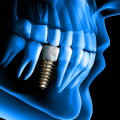 How Much Does it Cost to Get Dental Implants in Alabama?