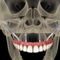 Can I Get a Dental Implant After a Sinus Lift Procedure?