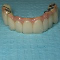 Which Option is Best for Replacing Missing Teeth: Dental Implants or Bridges?