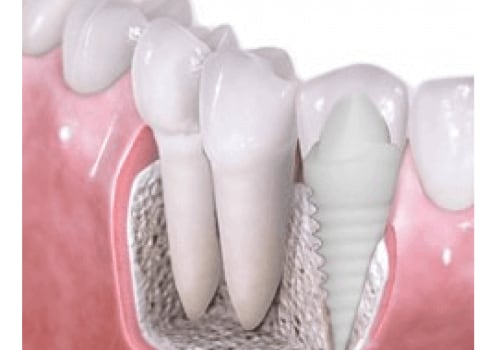 Recovery Time for Dental Implants: What You Need to Know
