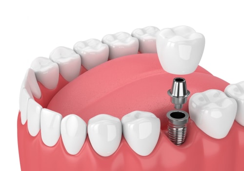 How Long Do Teeth Implants Last? An Expert's Guide to Longevity