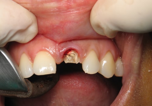How Long Does it Take to Get a Dental Implant? - An Expert's Perspective
