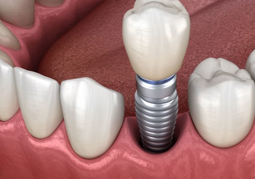 The Pros and Cons of Dental Implants: A Comprehensive Guide