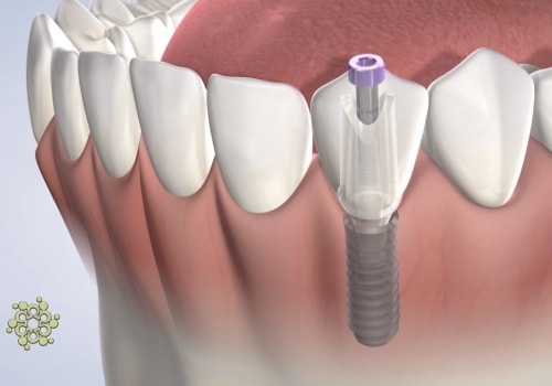 How Long Should You Take Off Work for Dental Implants? A Guide to Recovery