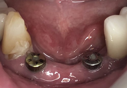 Do I Need an Oral Surgeon or a General Dentist for My Dental Implant?