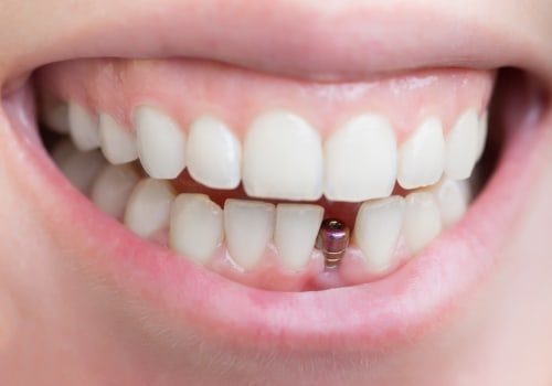 The Last Stage of a Dental Implant: What to Expect