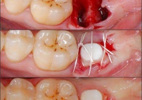How Long Does it Take for Gums to Heal After Implant Surgery?