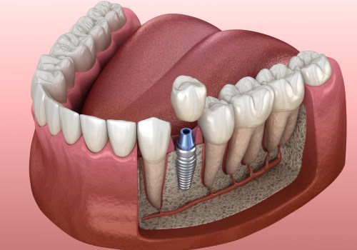What is the Best Option for Patients with Insufficient Bone Mass to Support a Dental Implant?