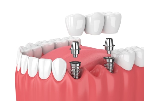 Getting a Dental Implant: A Comprehensive Step-by-Step Guide