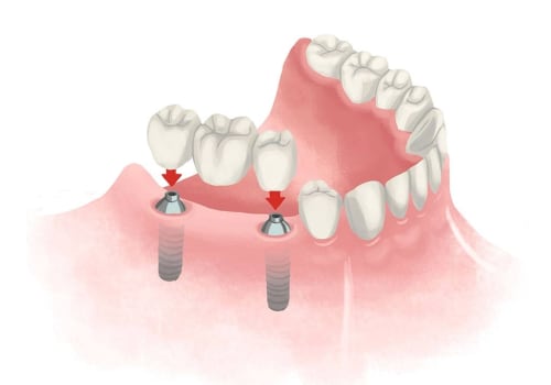 How Often Should You Get Your Dental Implants Checked? A Guide for Patients
